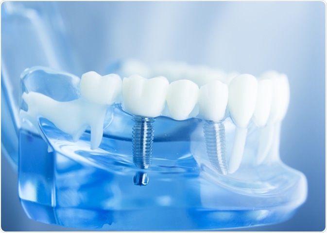 Dental implant. Image Credit: edwardolive / Shutterstock